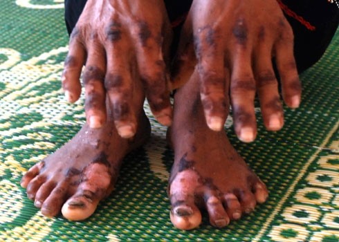 A patient with skin ulcers all over his hands and feet ( Photo: Tuoi tre)